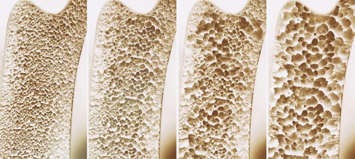 Osteoporosi: una conferenza e controlli gratuiti