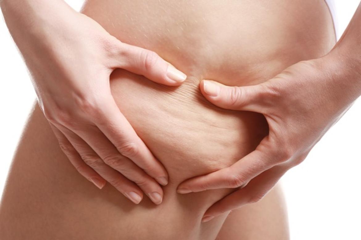 Ritenzione idrica, ecco come combatterla