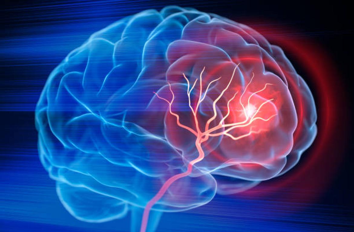 L&rsquo;associazione Alice Oltrep&ograve; e Lomellina sensibilizza sulla prevenzione dell&rsquo;ictus cerebrale