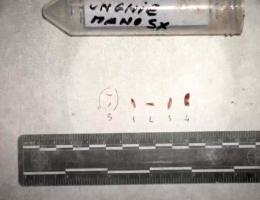 Delitto di Garlasco, le anticipazioni della nuova perizia genetica: Dna sulle unghie compatibile con quello di Andrea Sempio